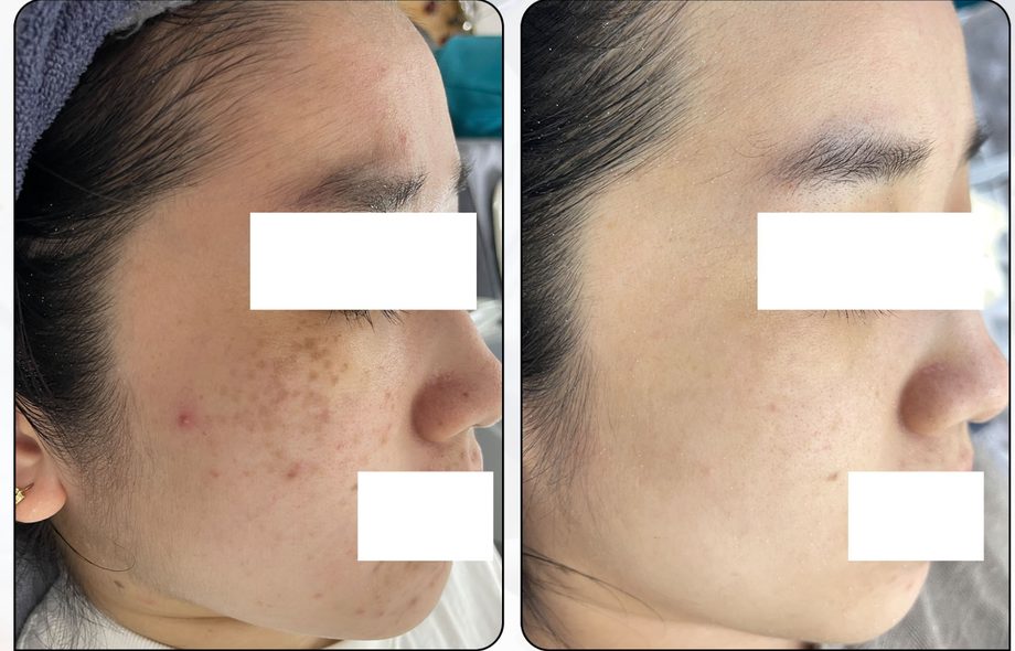 Khách hàng điều trị Bớt Hori — trước và sau
