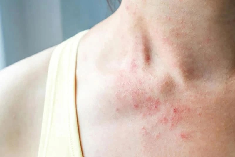 Bị nổi mụn do nóng trong người