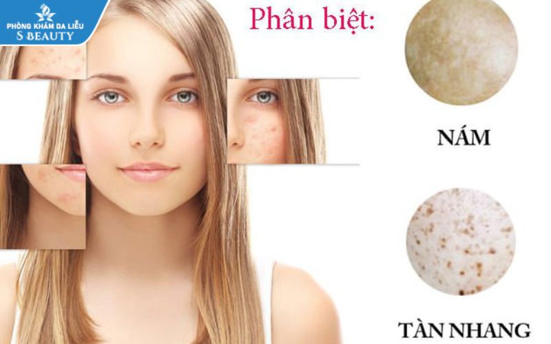 Phân biệt nám và tàn nhang cái nào dễ chữa hơn