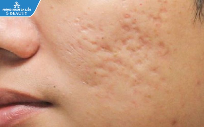 Khi nào thì bôi thuốc chống sẹo vào vết thương