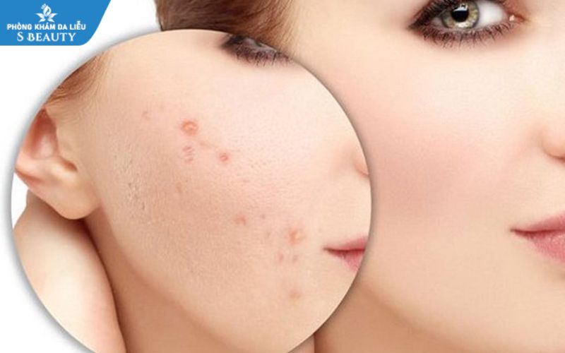Tẩy nốt ruồi bao lâu thì bôi kem trị sẹo để không bị thâm sẹo