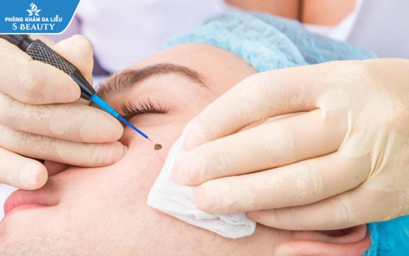 Điều trị sẹo sau khi bắn nốt ruồi