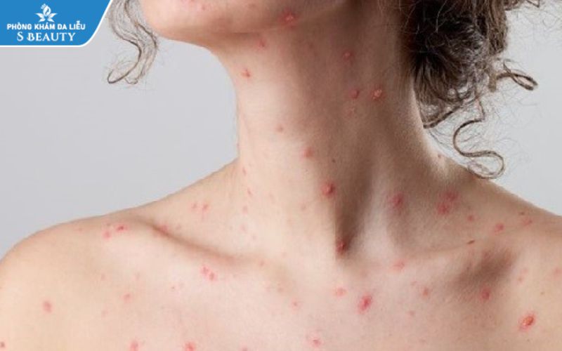 Bị thủy đậu kiêng ăn gì để không để lại sẹo?