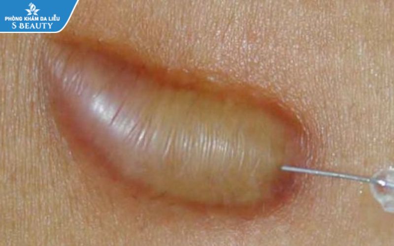 tiêm sẹo lồi bao lâu thì xẹp