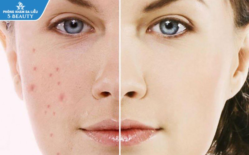 top kem trị sẹo thâm hiệu quả