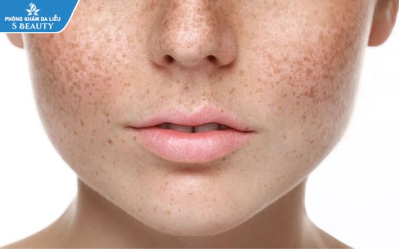 Trị bớt sắc tố bằng laser