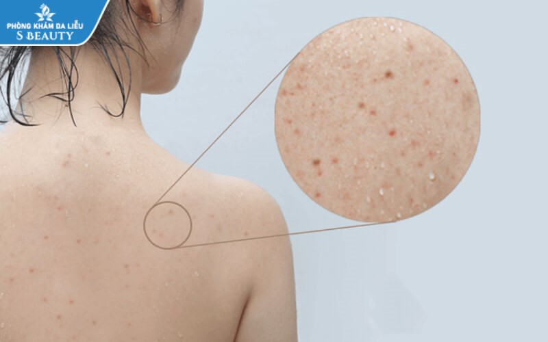 Có nên nặn mụn lưng không