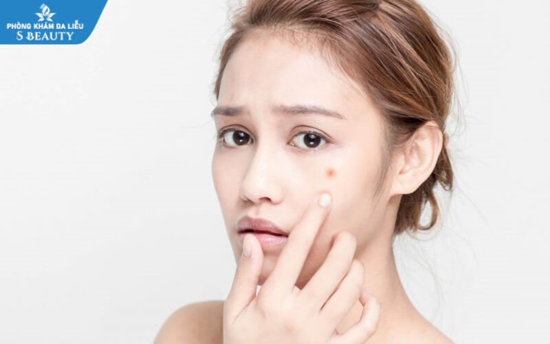 Đến tháng có nên nặn mụn không