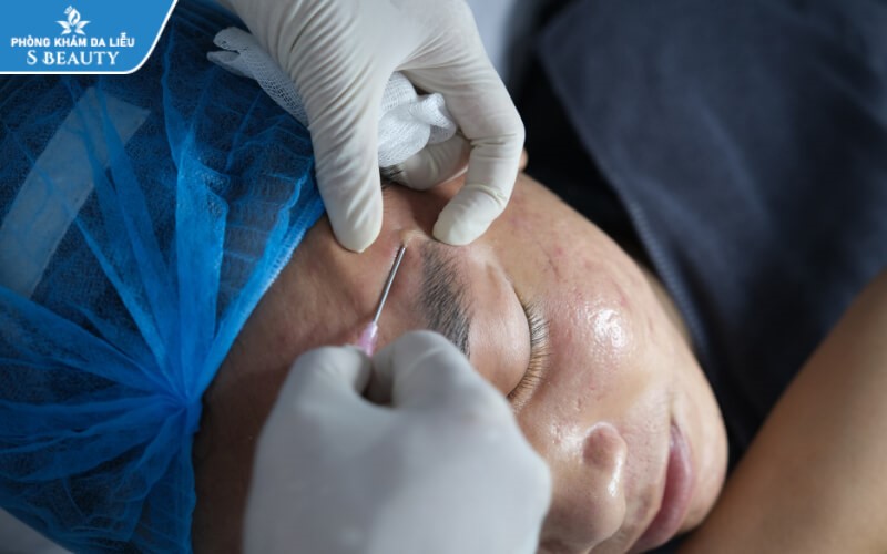 Tách đáy sẹo bao lâu thì hết?