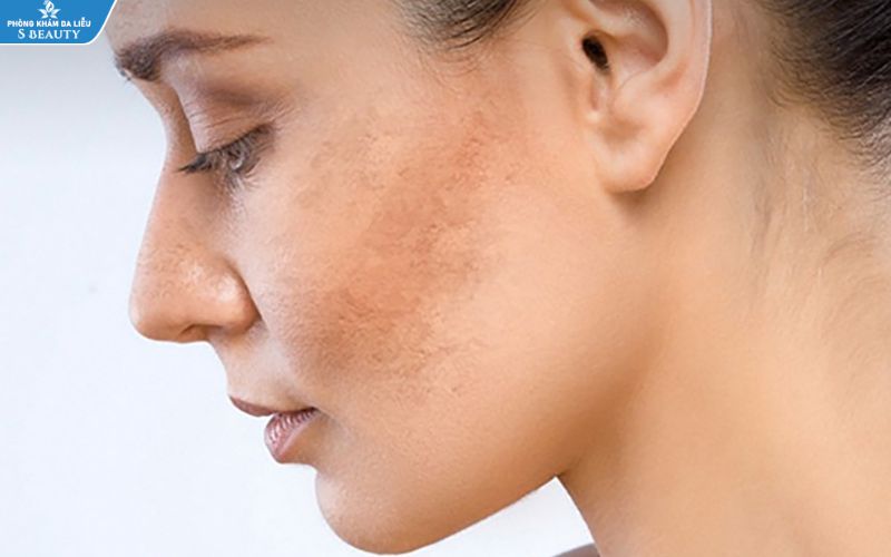 Liệu trình trị nám giá bao nhiêu?