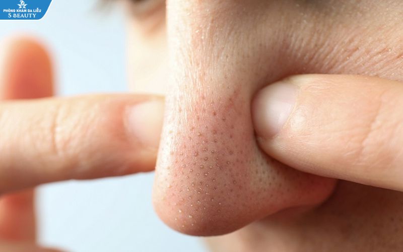 Trị mụn đầu đen ở mũi ngay tại nhà