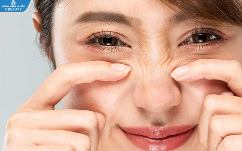 Cách trị mụn đầu đen ở mũi