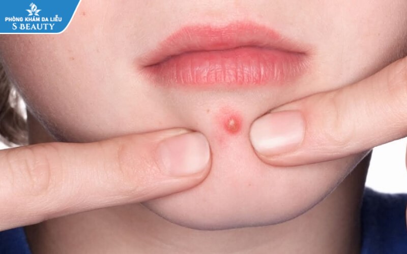 Có nên nặn mụn mủ không