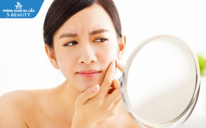 Bôi gì sau khi nặn mụn để da được hồi phục hiệu quả