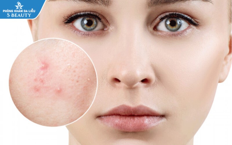 cách lấy nhân mụn không cần nặn