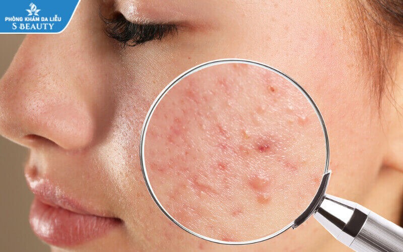 có nên nặn mụn trước kỳ kinh nguyệt