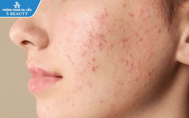 Dùng BHA đẩy mụn có nên đi nặn không?