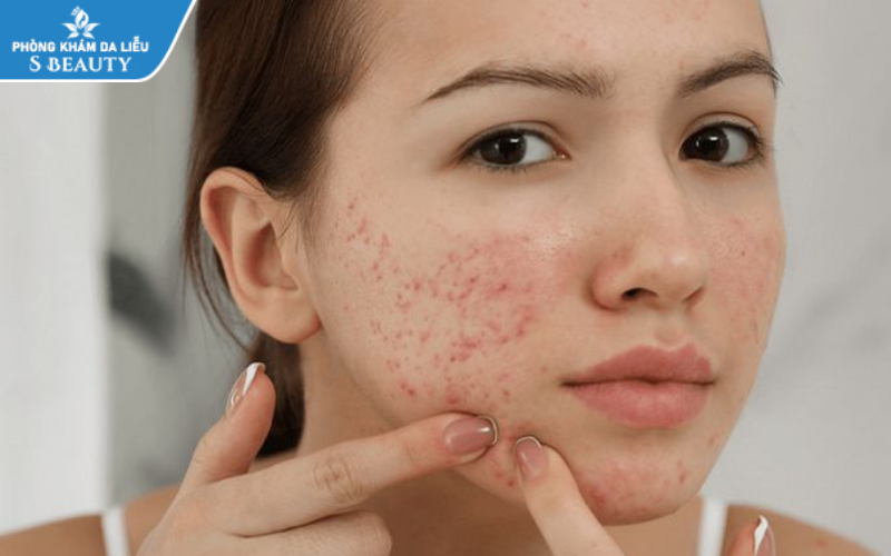 Megaduo có khả năng đẩy mụn nhưng còn kém và tùy thuộc khá nhiều vào tình trạng da mỗi người