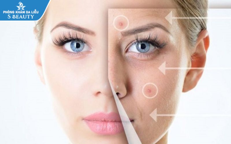 Tìm hiểu mụn viêm có nên nặn không