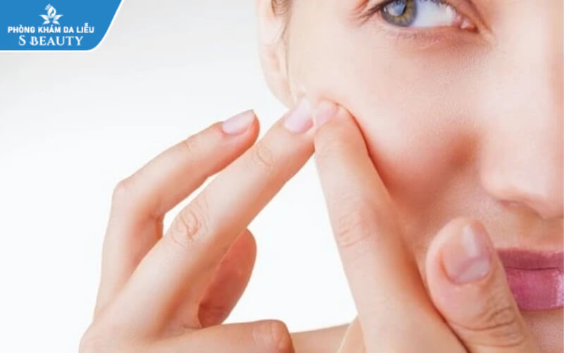 các sản phẩm nên dùng sau khi nặn mụn