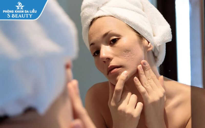 skincare cho da sẹo rỗ