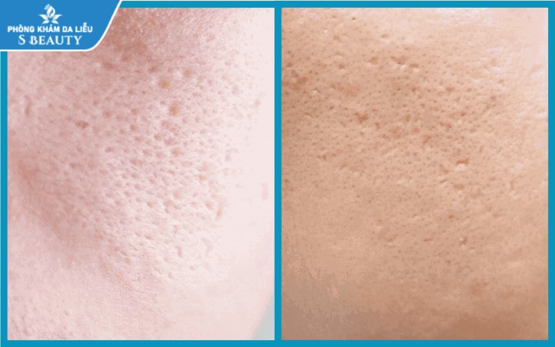 Phân biệt sẹo đáy nhọn và lỗ chân lông to