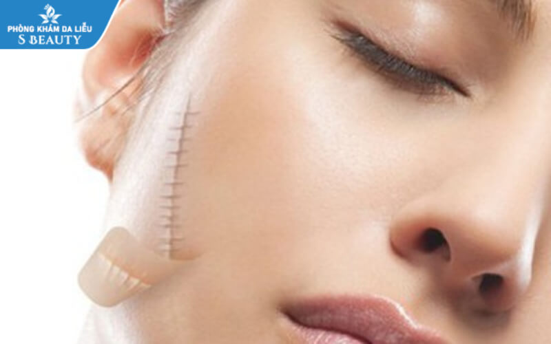 cách trị vết thương không để lại sẹo
