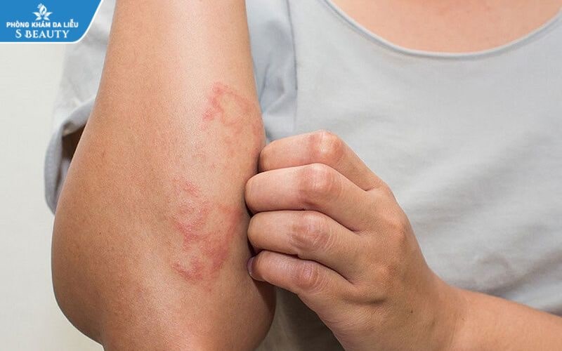 kem-triet-long-vinh-vien