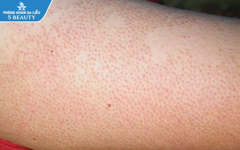 trị viêm nang lông ở chân tại nhà