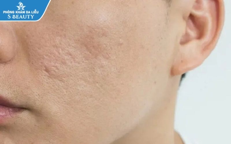 chăm sóc da mặt bị sẹo rỗ
