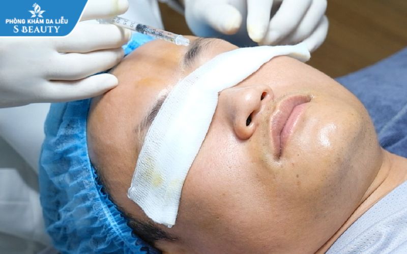 tiêm meso cần kiêng gì