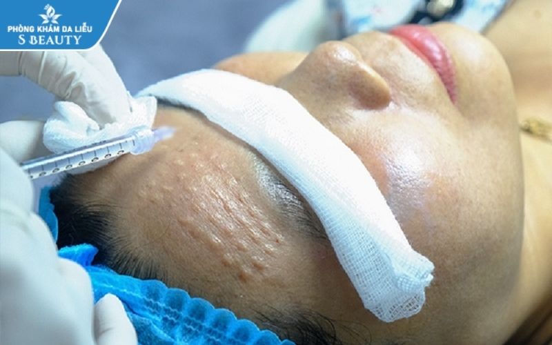 tiêm meso trị sẹo rỗ