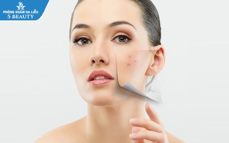 Mụn trứng cá có tự hết không