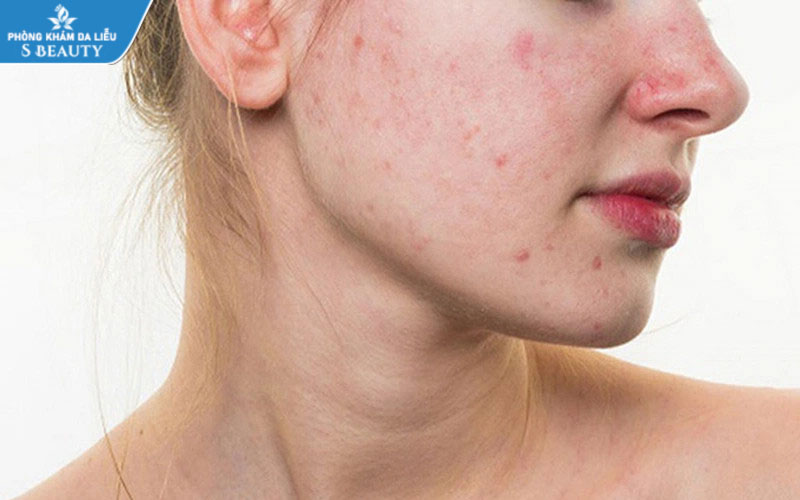 skincare-cho-da-tham-do