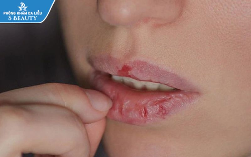 tac-dung-phu-cua-isotretinoin