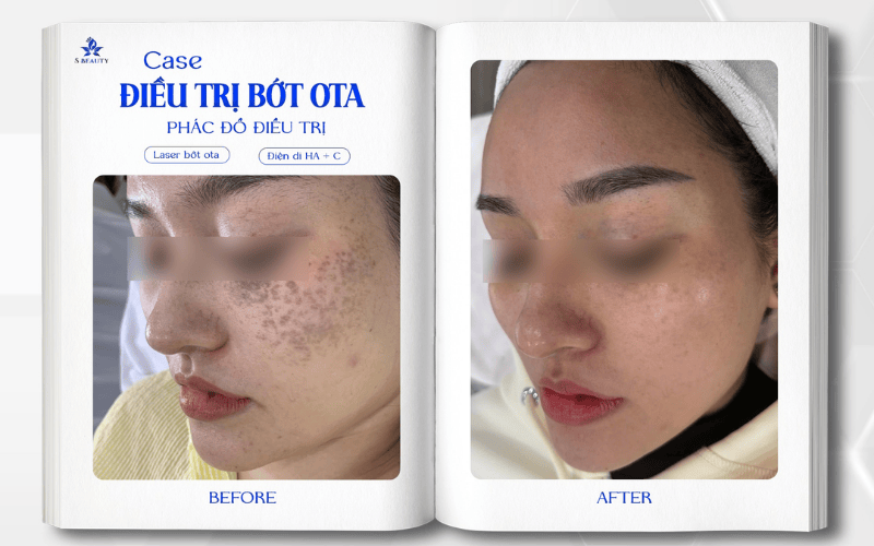 Khách hàng trị nám tại S BEauty