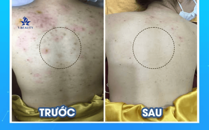 Cách Trị Mụn Lưng Ngăn Ngừa Tái Phát Triệt Để