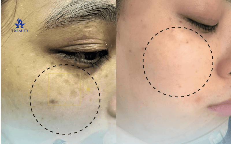 Tại Sao Nên Trị Nám Từ Gốc Bên Trong