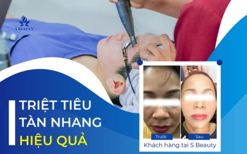 Chi Phí Điều Trị Tàn Nhang Bằng Laser (2)