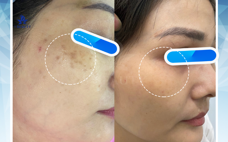 Công Nghệ Laser Tiên Tiến Kết Hợp PRP