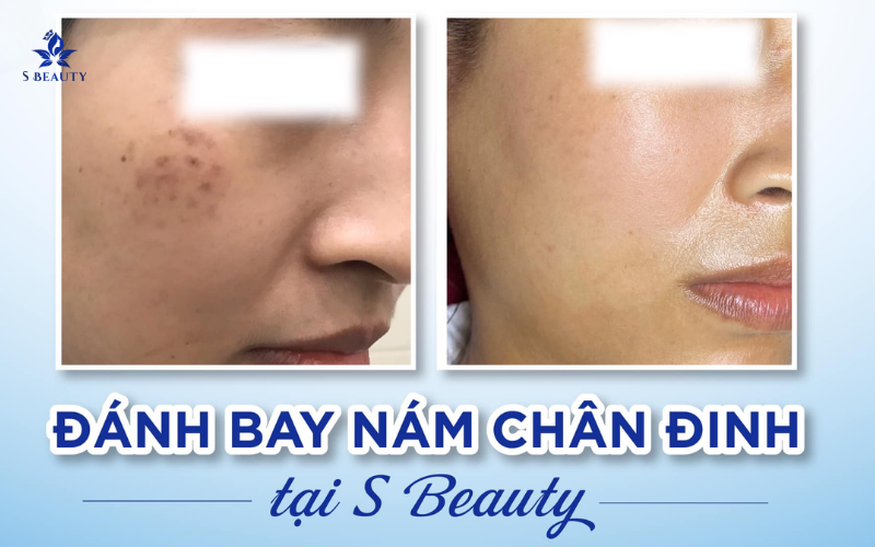 Hồi Phục Da Hoàn Hảo Sau Laser Trị Nám Với 5 Mẹo Đơn
