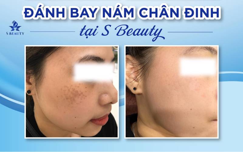 NÁM CHÂN SÂU CÓ TRỊ ĐƯỢC KHÔNG