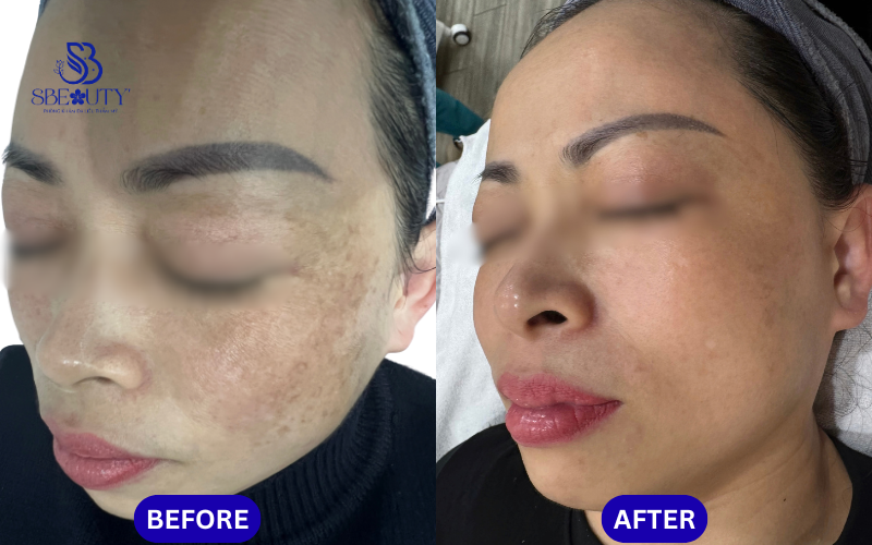 Hiệu quả điều trị nám tại S Beauty Thủ Đức