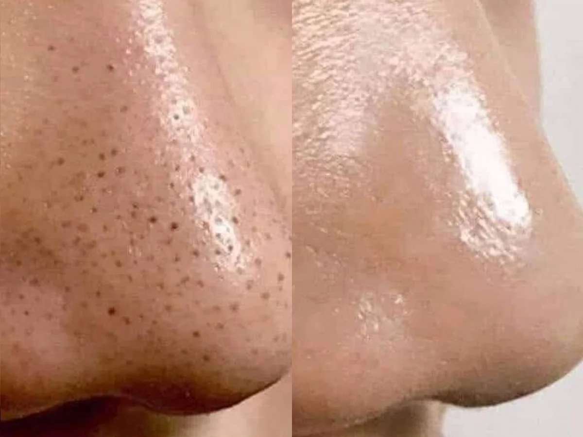 Vùng mũi cằm trước và sau khi nặn mụn y khoa tại S Beauty Thủ Đức