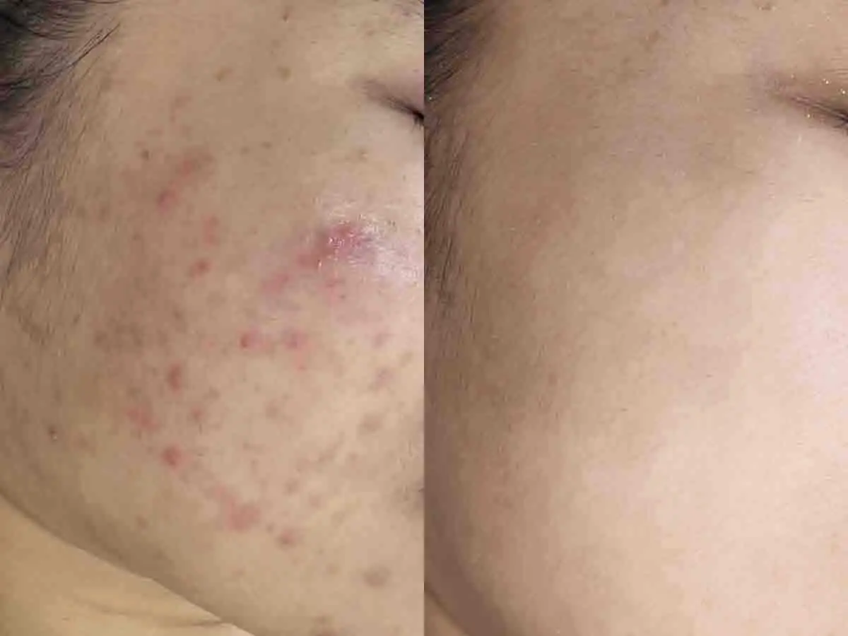 Ảnh trước và sau một ca điều trị mụn viêm tại S Beauty Thủ Đức