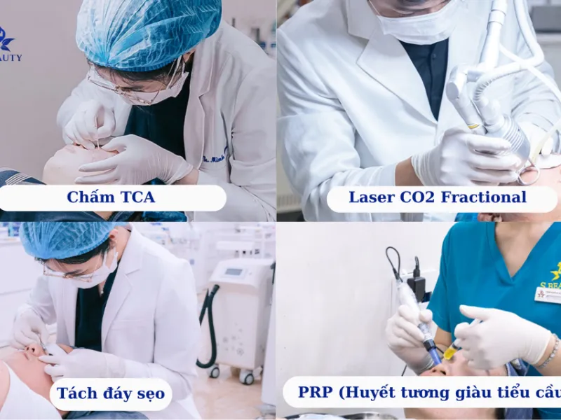 Bác sĩ thực hiện kỹ thuật chấm TCA điều trị sẹo rỗ