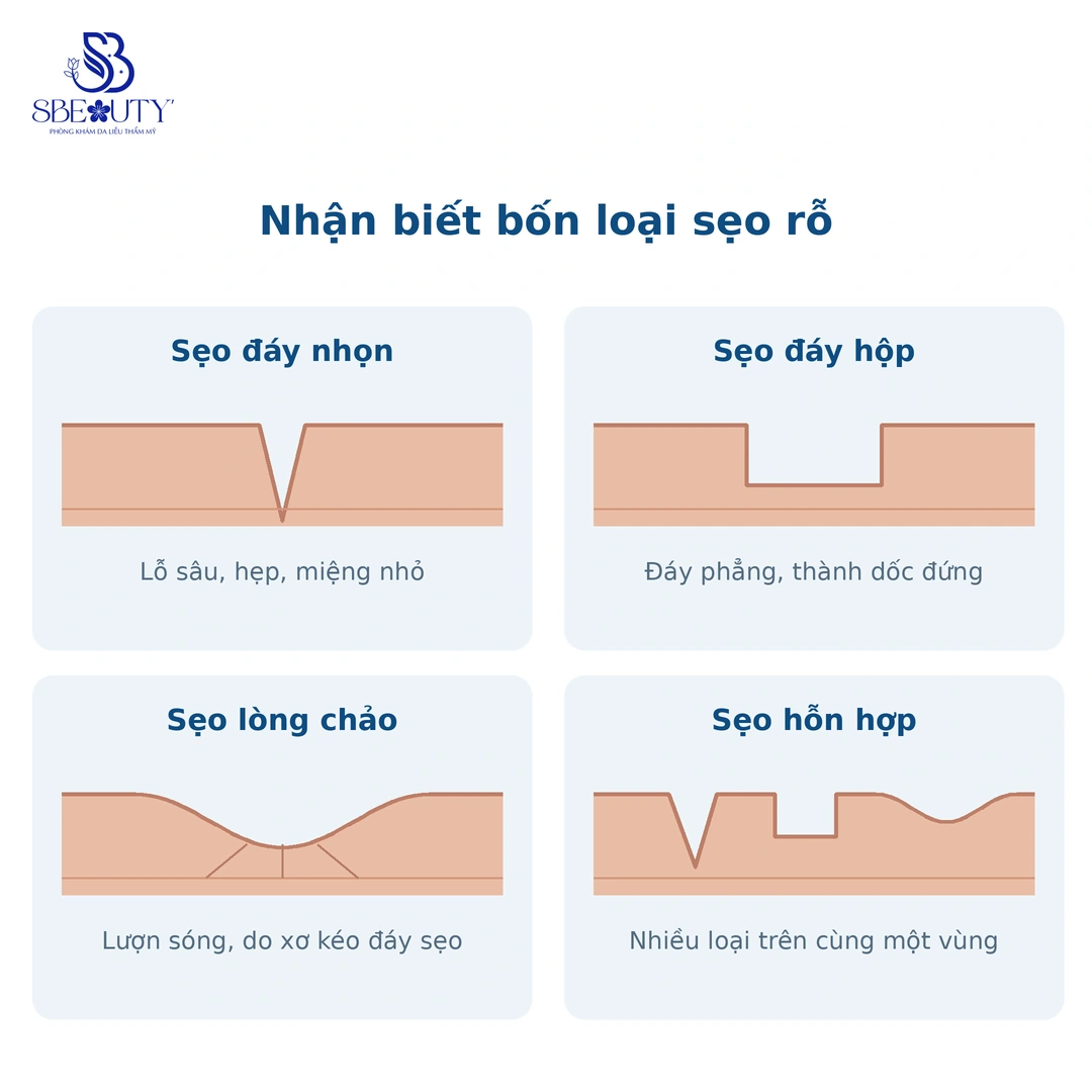 Đồ hoạ bốn loại sẹo rỗ trong bài S Beauty Thủ Đức