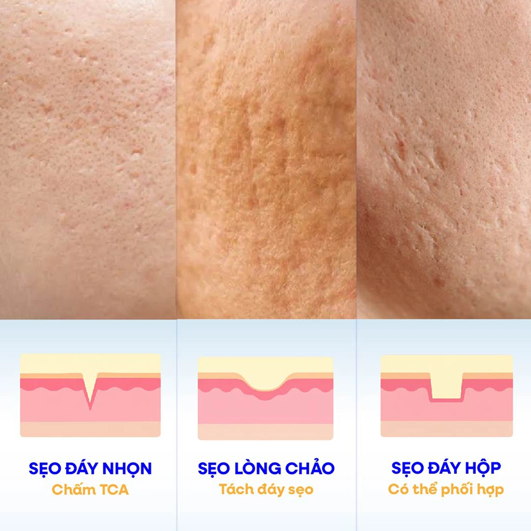Sơ đồ ba loại sẹo rỗ và phương pháp điều trị tại S Beauty Thủ Đức