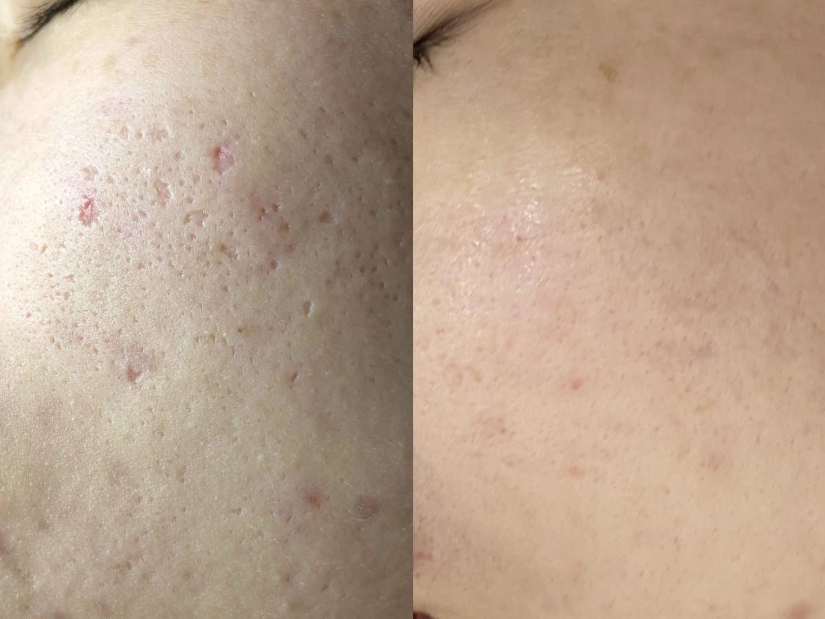 Ảnh trước và sau điều trị sẹo rỗ hỗn hợp tại S Beauty Thủ Đức