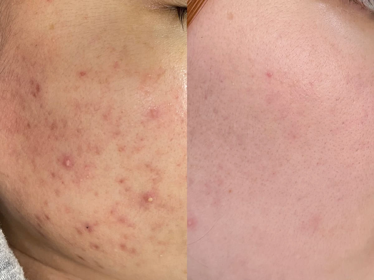 Ảnh trước và sau điều trị mụn viêm tại S Beauty Thủ Đức
